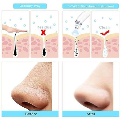 Derma Suction Cleaner Device