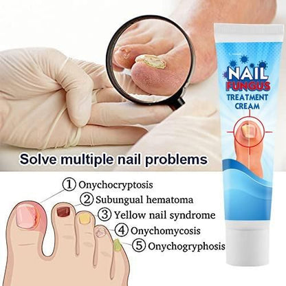 Nail Fungus Treatment Cream 100grm Pack of 2